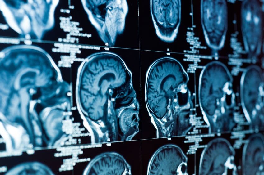 AI 融入放射治療 腫瘤輪廓勾畫更即時