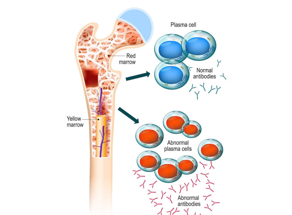 以端粒分析檢測多發性骨髓瘤！Telo Genomics攜手 Mayo Clinic