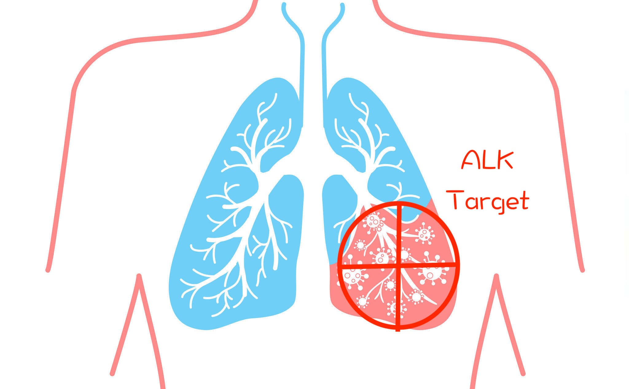 深度解析 ALK 肺癌標靶臨床試驗 ALEX：PFS 為史上最高？ OS 大預測？