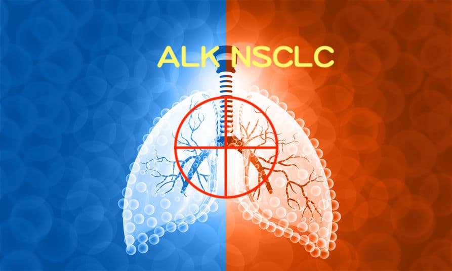 提升 ALK 肺癌 5 年存活率！ Alectinib 勝過於 Crizotinib