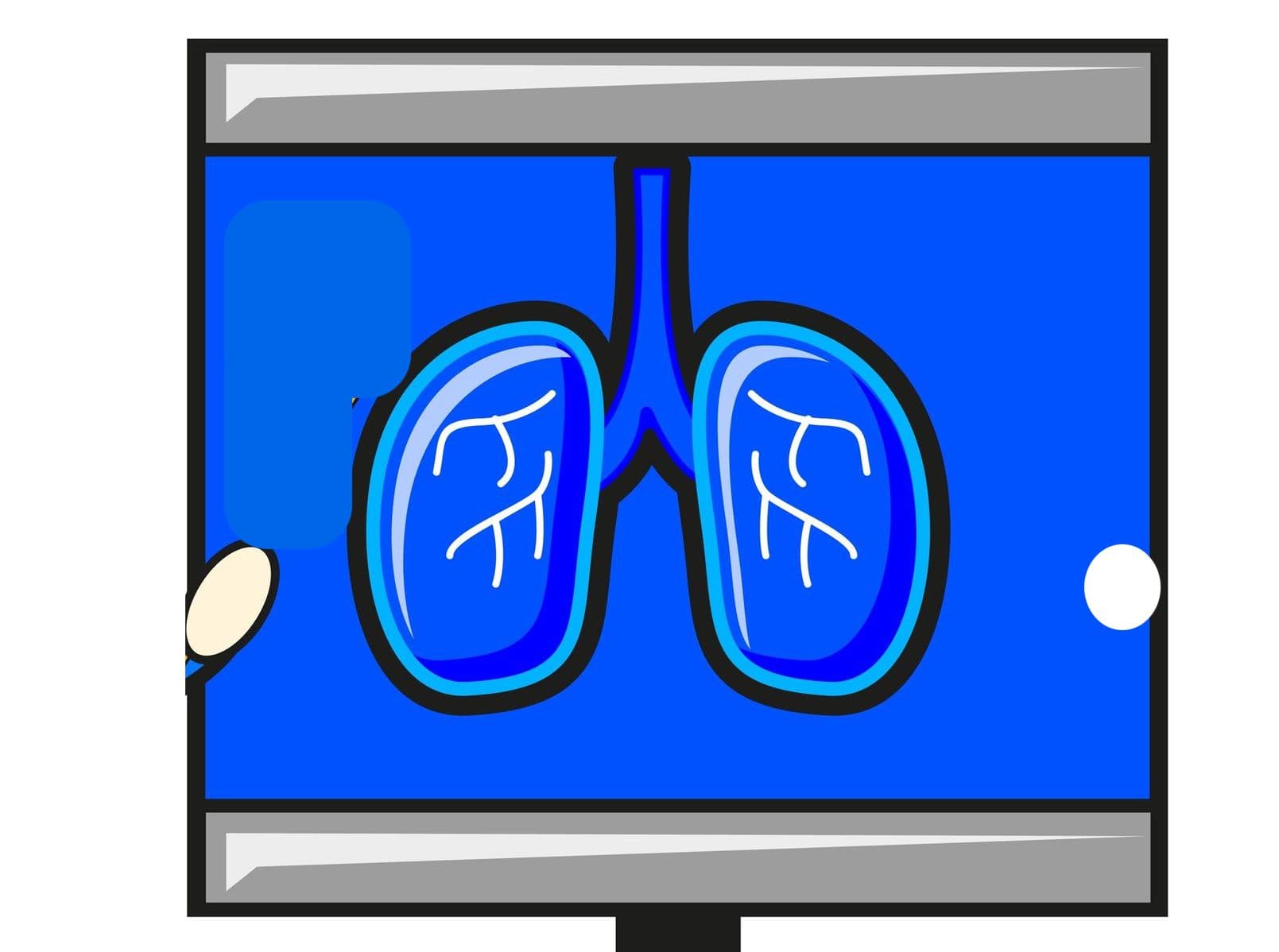 雙免疫新藥抗 NSCLC？ Arcus Biosciences 攜手 AstraZeneca 推 3 期臨床試驗