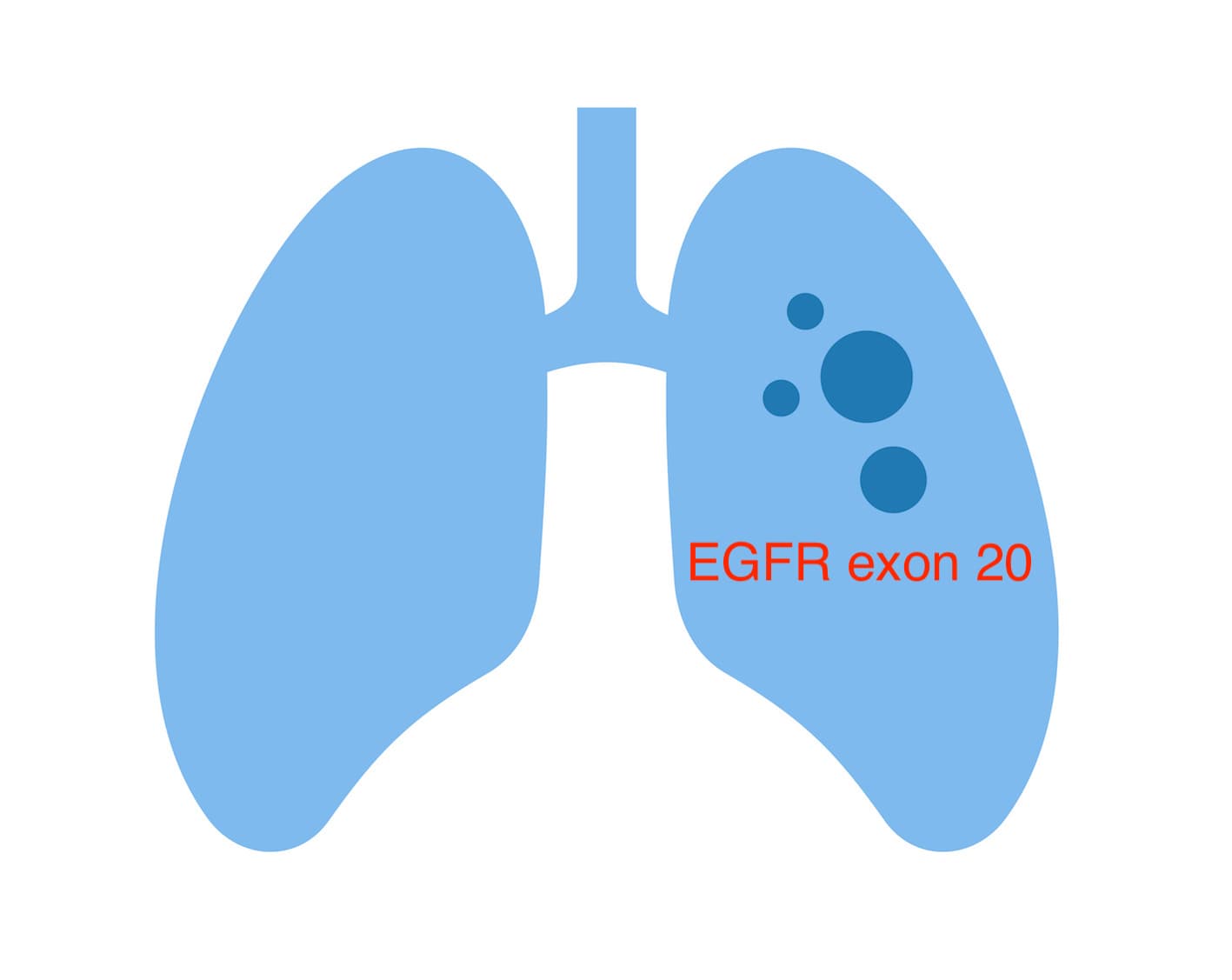 雙特異性抗體 amivantamab 突破 EGFR exon 20 突變肺癌治療困境？