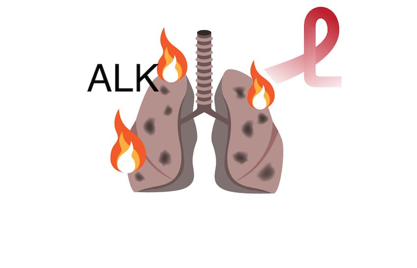 ALK 二代標靶 Ceritinib 減量、增效抗肺癌？ 解析亞洲族群最新數據