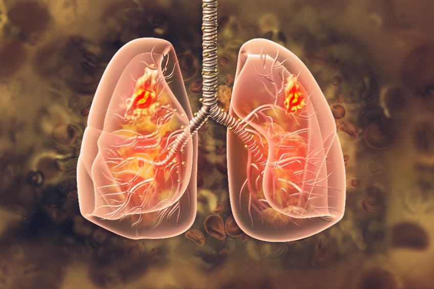 探索急性呼吸窘迫新療法，CFTR 調節劑現潛力