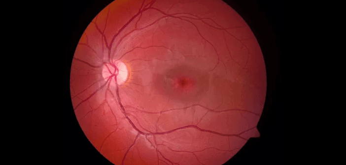 萎縮性黃斑部病變，通常表現為「靶心」狀圖案。（來源：American Academy of Ophthalmology）